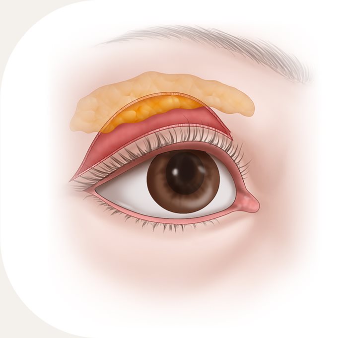 절개 쌍꺼풀 수술 그림 : 눈꺼풀을 절개해 지방과 근육을 제거하는 모습