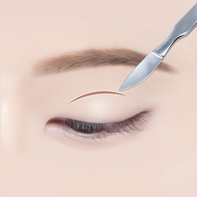 STEP 01 원하는 높이, 라인에 맞춰 디자인을 진행하고, 라인에 맞게 눈꺼풀을 최소 절개합니다.