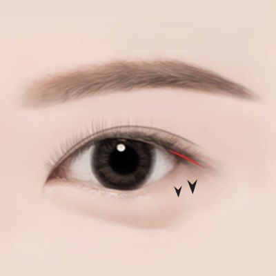STEP 02 눈꼬리를 섬세하게 절개한 후 디자인한 각도로 내려줍니다.