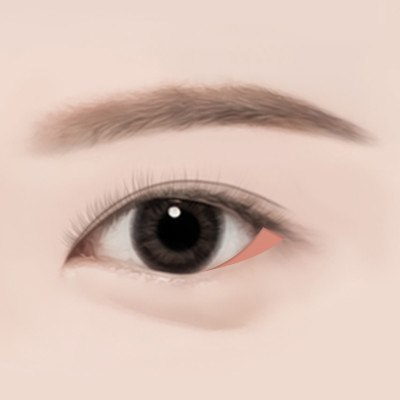 STEP 03 다시 붙지 않도록 골막에 단단히 고정합니다.