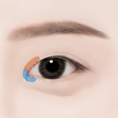 STEP 03 눈 앞머리 근육과 피부를 섬세하게 박리한 후 디자인에 맞게 재배치합니다. 남는 피부는 절제하고 미세하게 봉합합니다.