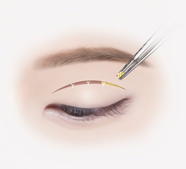 쌍꺼풀 라인이 너무 두꺼운 경우 - 지방재배치 또는 지방이식