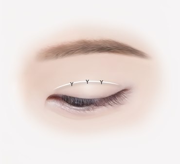 양쪽 쌍꺼풀 높이가 다른 경우 - 적절한 높이로 교정