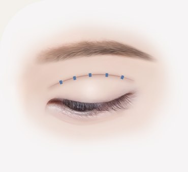 양쪽 쌍꺼풀 높이가 다른 경우 - 기존 유착을 풀어 박리