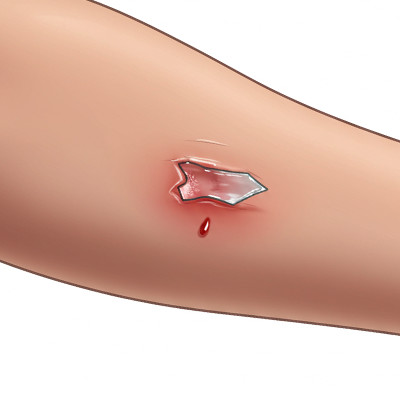 STEP 04 이물질이 깊이 박혀 있거나, 상처가 크고 깊은 경우에는 억지로 손대지 말고 지혈만 한 상태로 병원에 내원하세요.