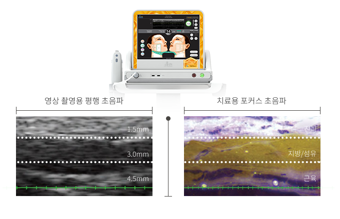 울쎄라 장비와 영상 촬영용 평행 초음파(1.5mm / 3.0mm / 4.5mm), 치료용 포커스 초음파(진피 / 지방·섬유 / 근육) 화면