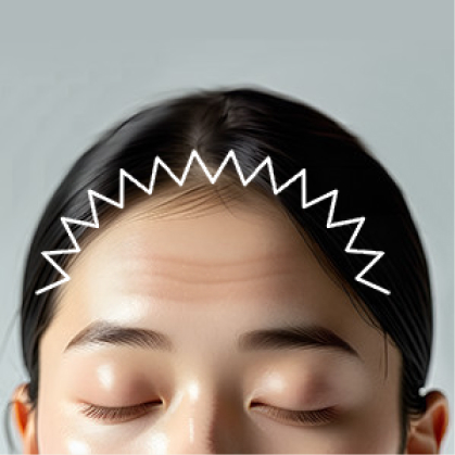 STEP 01 지그재그 모양으로 잔머리 손상과 흉터를 최소화하여 절개합니다.