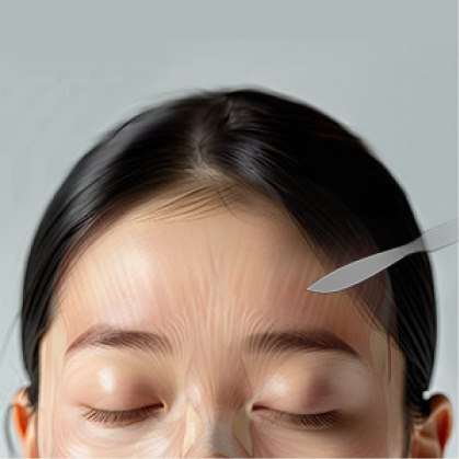 STEP 02 전두근과 상안와신경을 보존하며 이마 피부를 절제합니다.
